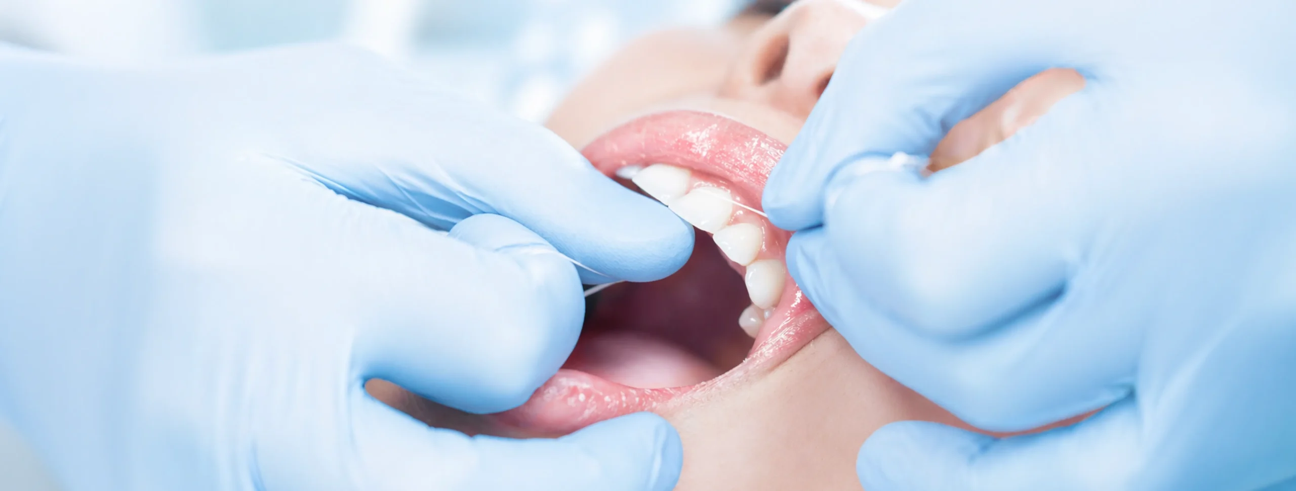 Close-up of a dentist checking the gum margins between upper front teeth during a gum recession assessment