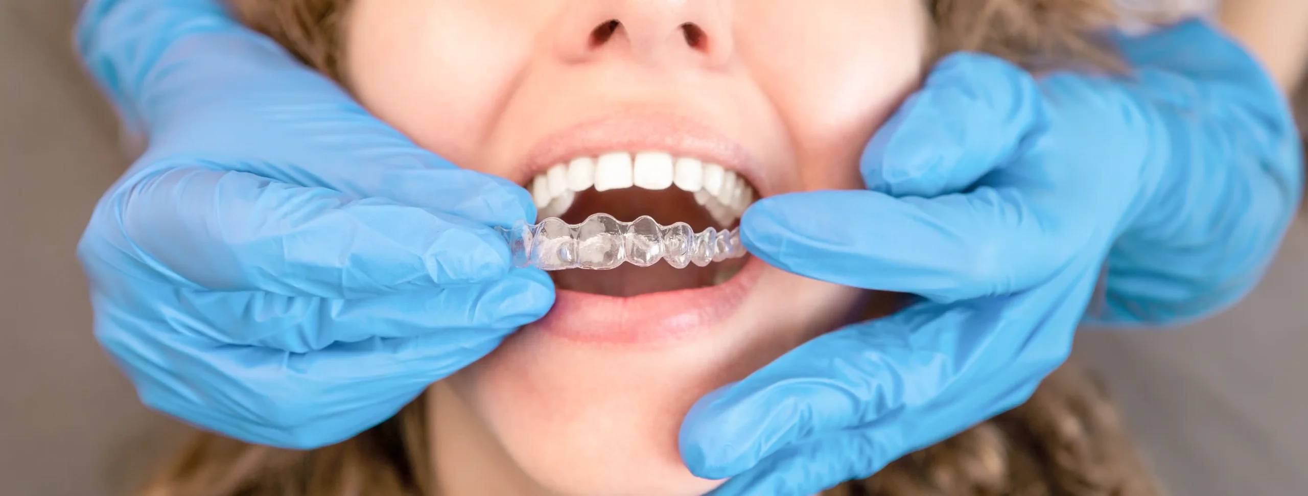 Gloved dentist carefully fitting a clear occlusal splint onto a patient's lower teeth