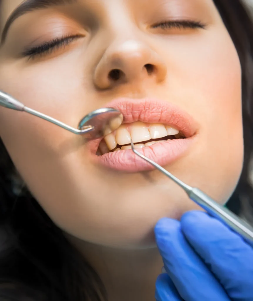 Close-up of a patient's lower front teeth being examined with a dental mirror and scaler showing visible calculus buildup