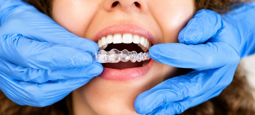Dentist fitting a clear aligner tray onto a patient's upper teeth