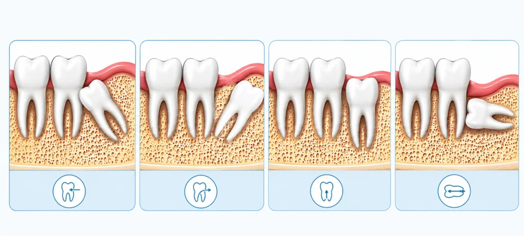 Diagram showing four types of wisdom tooth impaction: mesial, distal, vertical, horizontal