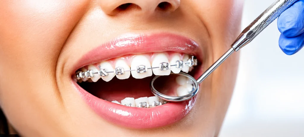 Close-up of a patient's smile with metal braces during a dental check-up