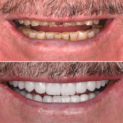 Before and after full mouth rehabilitation showing smile restoration