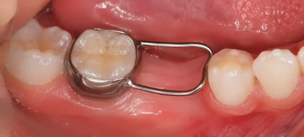 Band and loop space maintainer holding a gap in a child's lower teeth