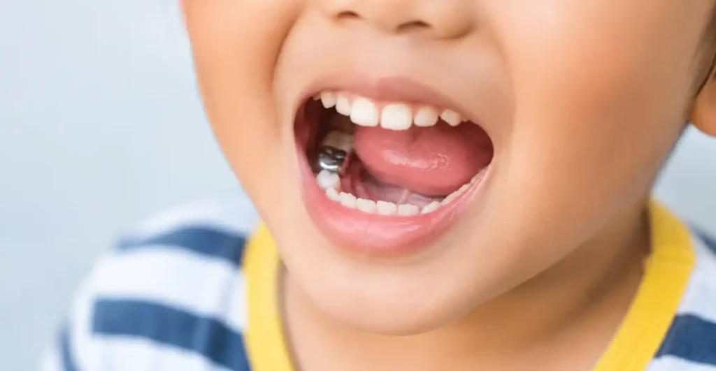 Child's open mouth showing a stainless steel crown on a lower back molar