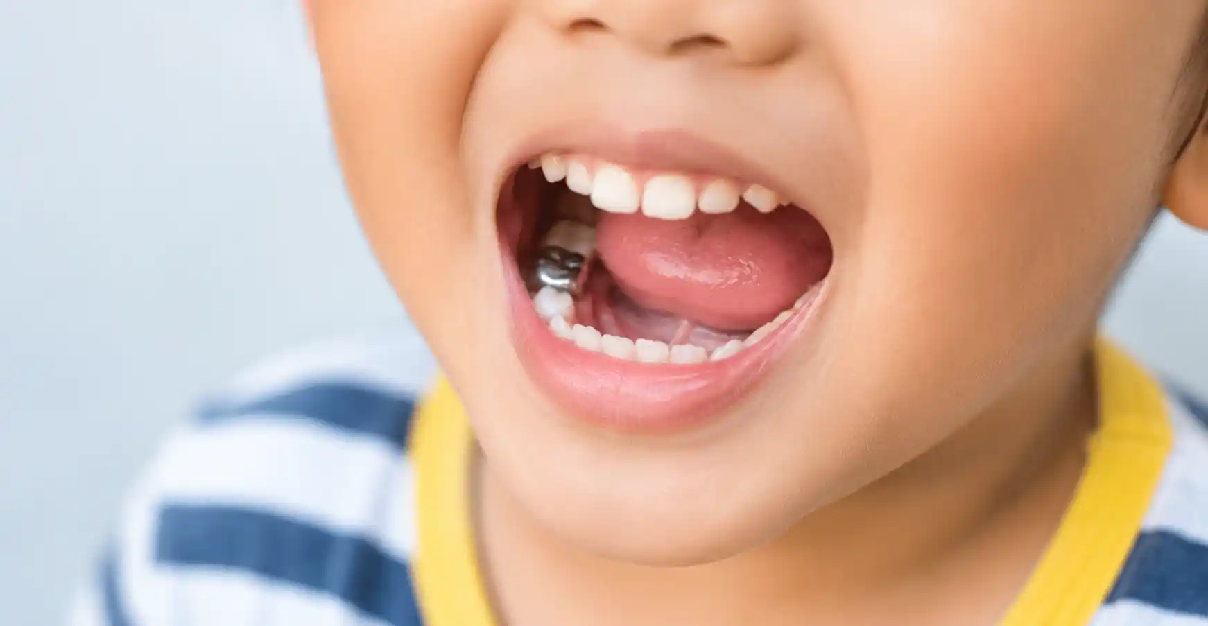 Child's open mouth showing a stainless steel crown on a lower back molar
