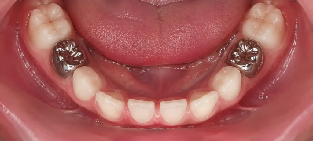 Stainless steel crowns fitted on a child's lower baby molars