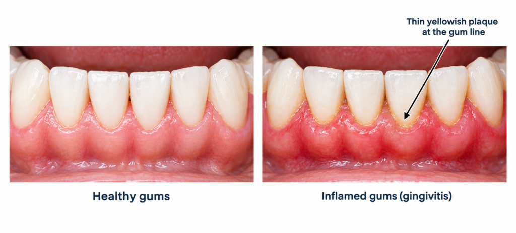 Healthy pink gums beside red inflamed gingivitis gums with plaque marked at the gum line