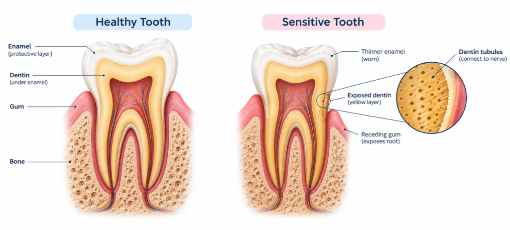 Tooth cross-section diagram comparing a healthy tooth with a sensitive tooth with worn enamel and receding gum