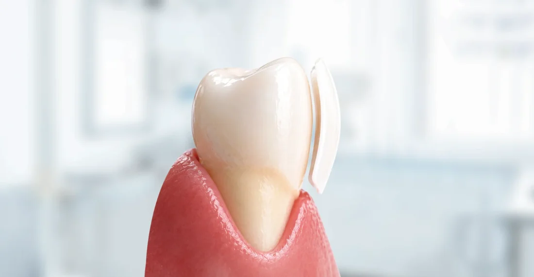 Model of a dental veneer being placed on a single human tooth.