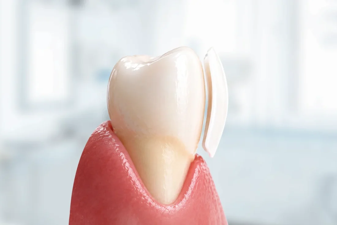 Model of a dental veneer being placed on a single human tooth.