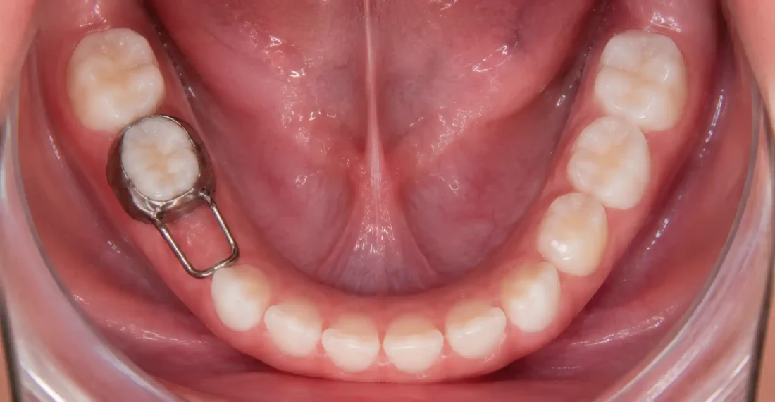 Band and loop space maintainer on a lower baby molar viewed from above
