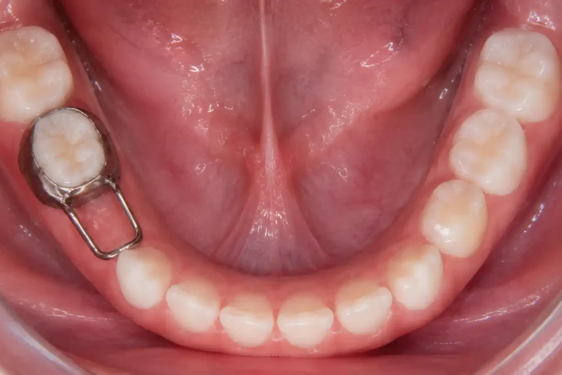 Band and loop space maintainer on a lower baby molar viewed from above