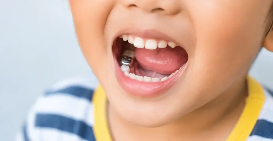 Child's open mouth showing a stainless steel crown on a lower back molar