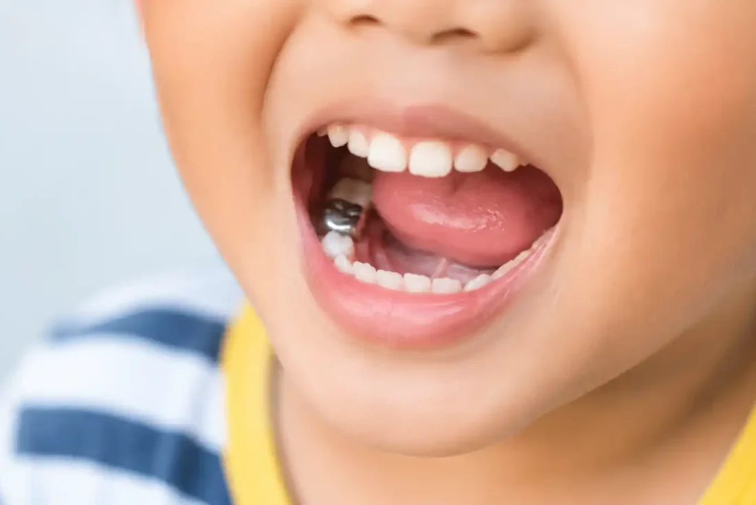 Child's open mouth showing a stainless steel crown on a lower back molar